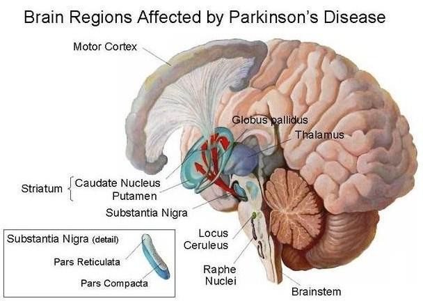 parkinson