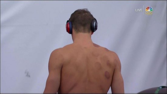 Rio 2016: Αγωνία και απορία για τα μεγάλα κόκκινα σημάδια στο σώμα του Phelps
