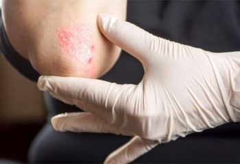 Παγκόσμια έρευνα: Πόσο ευτυχισμένοι είναι οι άνθρωποι με ψωρίαση; – Η θέση της Ελλάδας