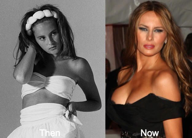 melania-trump-boob-job