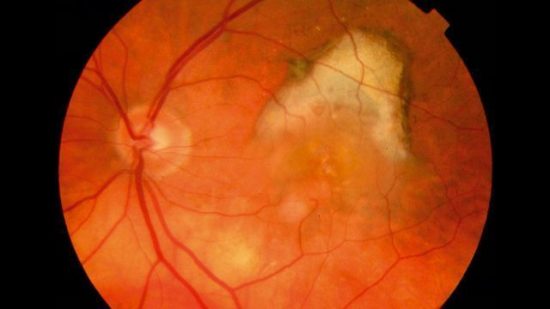Brolucizumab: Νέα στοιχεία για τη θεραπεία της ηλικιακής εκφύλισης της ωχράς κηλίδας