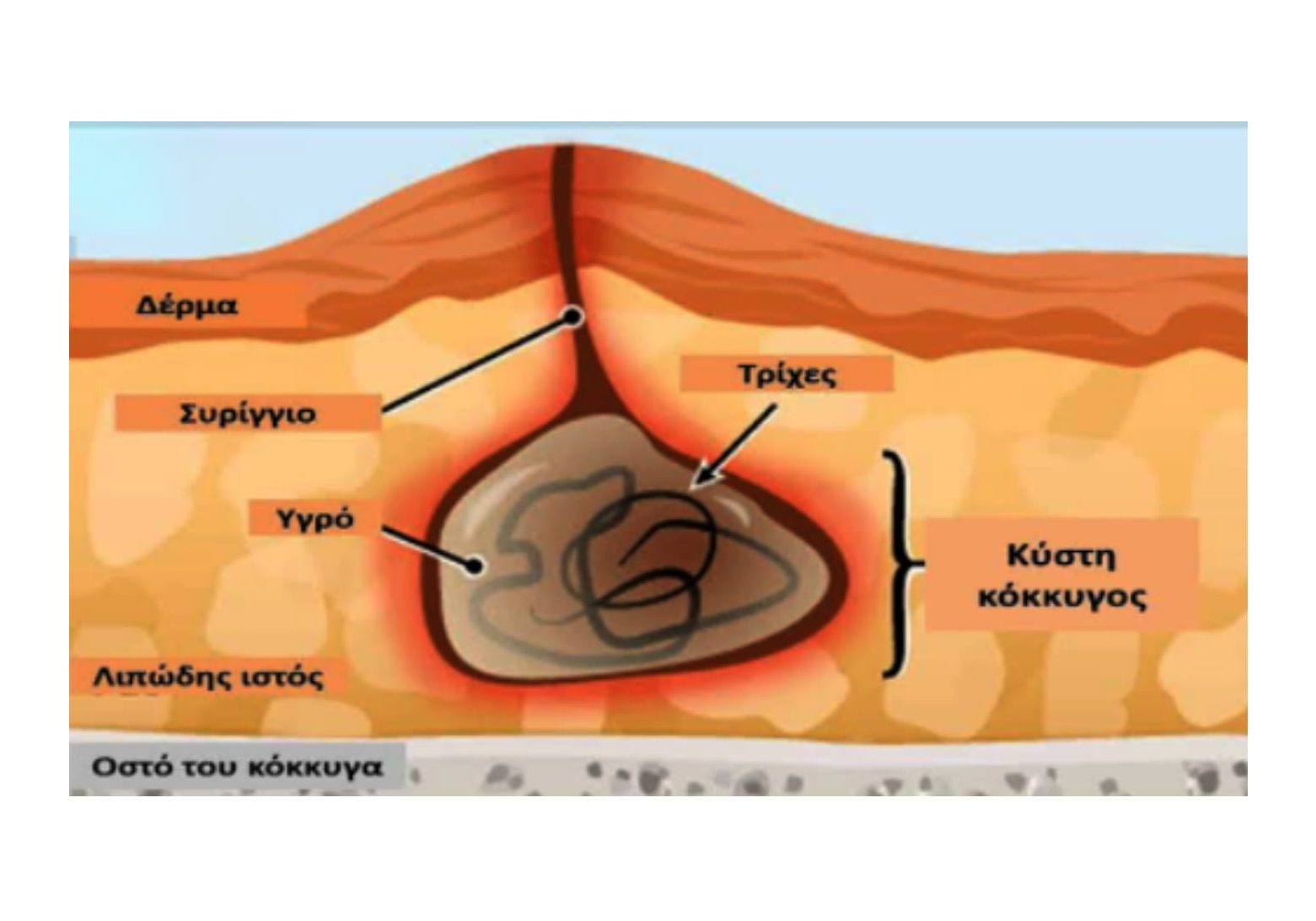 Κύστη Κόκκυγος: Πρόληψη και θεραπεία με Laser