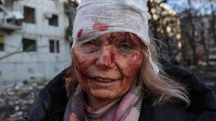 Φωτογραφία γυναίκας τραυματία μετά από ρωσικό βομβαρδισμό στην Ουκρανία