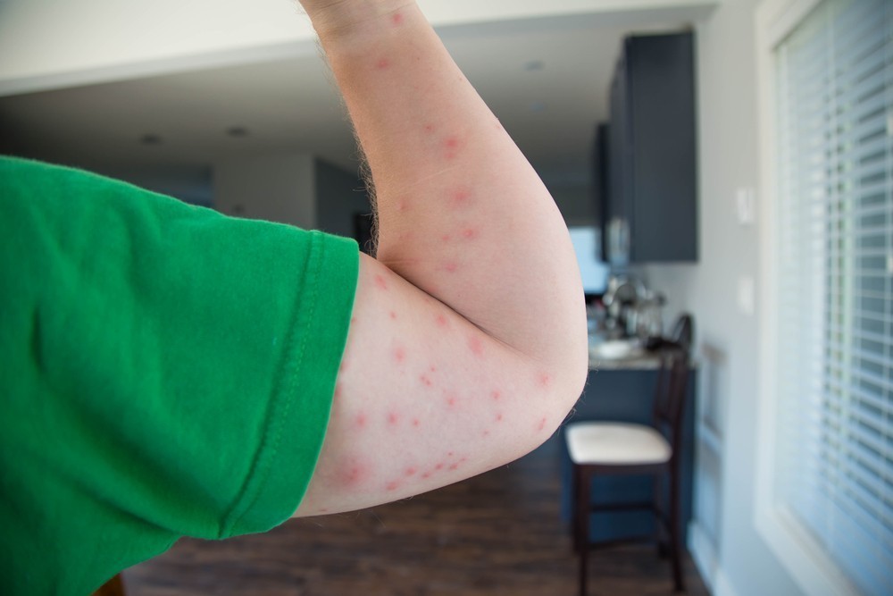 ΕΟΔΥ: 13 κρούσματα από τον ιό του Δυτικού Νείλου – Προφυλαχθείτε από τα κουνούπια