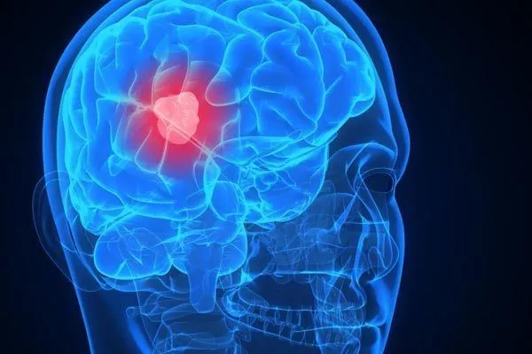 Μηνιγγίωμα: Ο πιο συχνός τύπος πρωτοπαθούς όγκου του εγκεφάλου | Δρ.  Χαράλαμπος Σεφέρης | Νευροχειρουργός